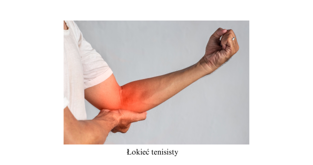 Łokieć tenisisty